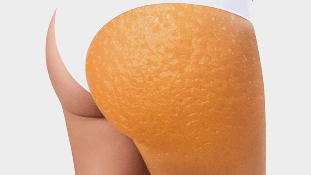 Откуда берется целлюлит и как от него избавиться Откуда берется целлюлит и как от него избавиться
