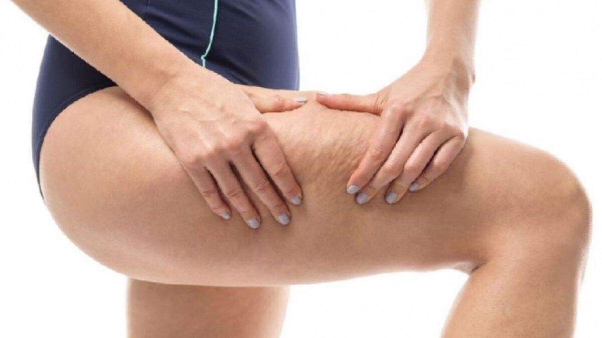 Как бороться с целлюлитом Как бороться с целлюлитом